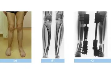 Boy Uzatan Kür Tarifi ve Malzemeleri